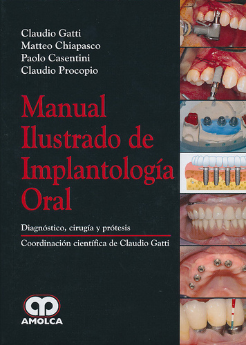 MANUAL ILUSTRADO DE IMPLANTOLOGIA ORAL - Chiapasco