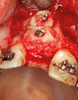 Implantes en áreas estéticas: Conceptos actuales en cirugía e implantes - F. Hayashi E Luiz Ramos Junior