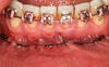 Implantes en áreas estéticas: Conceptos actuales en cirugía e implantes - F. Hayashi E Luiz Ramos Junior