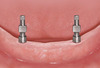 The Mandibular  Two-Implant Overdenture . First-Choice Standard of Care for the Edentulous Denture Patient - J. Carpentieri/ D.Tarnow