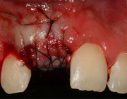 Cirugía Plástica oral - Carranza