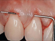 Treatment of Gingival Recession - Part 2 of Achieving Esthetic Predictability in Periodontology (2 Part Series) - Saadoun