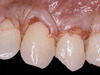 Crown Lengthening - Part 1 of Achieving Esthetic Predictability in Periodontology (2 Part Series) - Saadoun