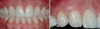 Esthetic Dentistry - 2 Layer Composite Restorations - Dietschi