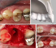 Implant placement in fresh extraction sockets: Key decision factors - Mariano Sanz