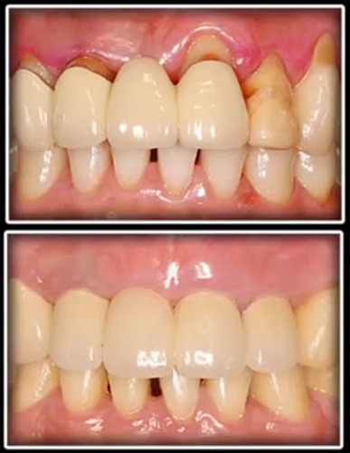 Predictable Soft Tissue Grafting for Esthetics in Thin Periodontium - Lin