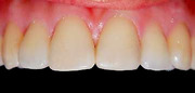 Color en Odontologia - Restauraciones Directas con Composites - Maravankin