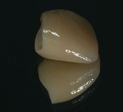 Zirconia Based Restorations for Esthetic Results and Longevity - Paul