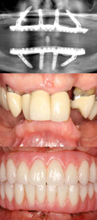 Diagnosis and Treatment Planning, Concepts of Immediate Loading - Jivraj / Zarrinkelk