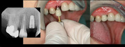 The 3D Click Guide - A New Direction for Model-Based Guided Implant Placement - Stumpel