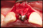 Predictability of the Extraction Site Implant Part 2: Maxillary Anterior Implant Case Protocol - Aalam