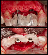 Predictability of the Extraction Site Implant Part 1: Do We Need a Buccal Plate? - Aalam