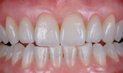 Previsualization in Esthetic Dentistry - A Useful System for Truly Informed Esthetic Treatment - Mintrone