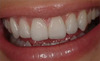 No Post No Crown - Biomimetic Restorative Dentistry - Pascal Magne