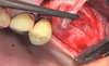 rhBMP-2 Grafting for Socket, Ridge and Sinus Augmentation - Jovanovic / Wikesjö