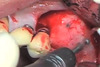 rhBMP-2 Grafting for Socket, Ridge and Sinus Augmentation - Jovanovic / Wikesjö