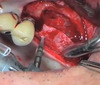 rhBMP-2 Grafting for Socket, Ridge and Sinus Augmentation - Jovanovic / Wikesjö