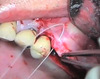 rhBMP-2 Grafting for Socket, Ridge and Sinus Augmentation - Jovanovic / Wikesjö