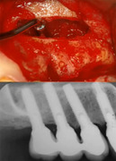 Soft Tissue Management and Grafting around Dental Implants - Esthetic and Mucogingival solutions - Jovanovic