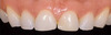 All Ceramic Restorations: Achieving Esthetic Excellence - Fradeani