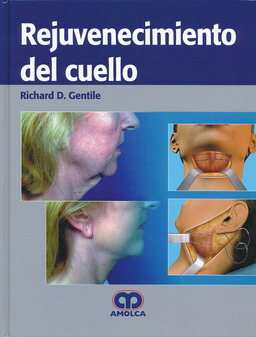 Rejuvenecimiento del Cuello - Gentile