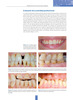 PROTESIS IMPLANTAR VENTAJAS COMPLICACIONES Y SOLUCIONES PRACTICAS - Bruna/ Fabianelli 