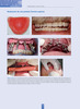 PROTESIS IMPLANTAR VENTAJAS COMPLICACIONES Y SOLUCIONES PRACTICAS - Bruna/ Fabianelli 