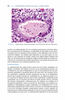 INTERPRETACION DE BIOPSIA DEL CUELLO Y CUERPO UTERINO - Malpica