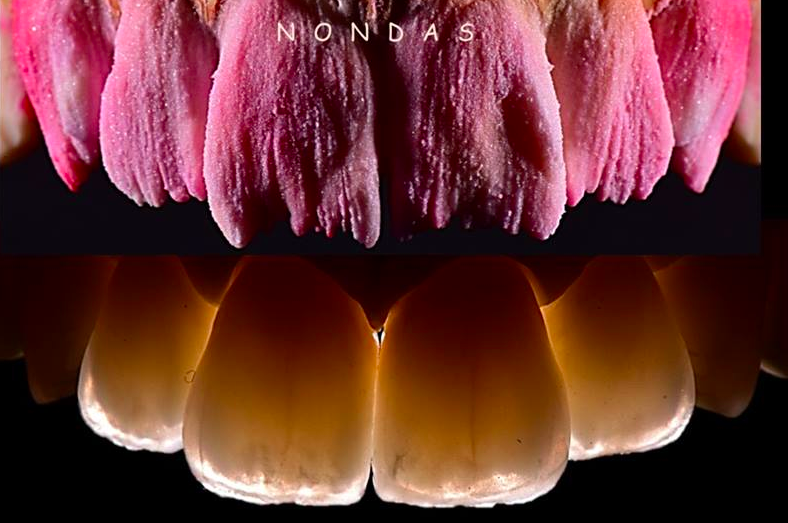 3 coronas + 3 carillas ips emax - Nondas Vlachopoulos - Dental Training Center